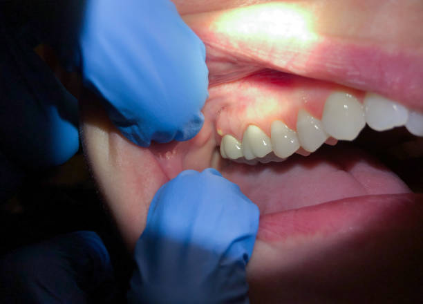 Best Dentist for Tooth Abscess  in Morgan Hill, CA