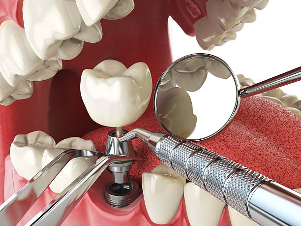 Best Urgent Tooth Repair  in Morgan Hill, CA